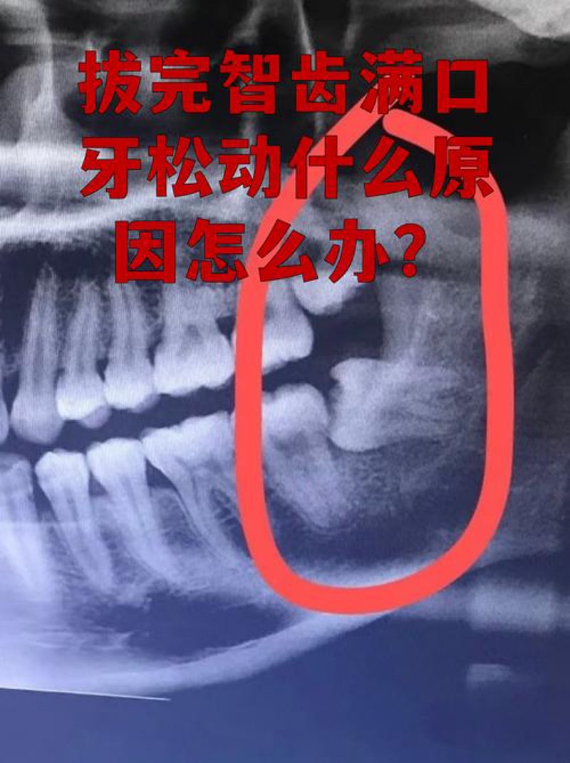 根管治疗
