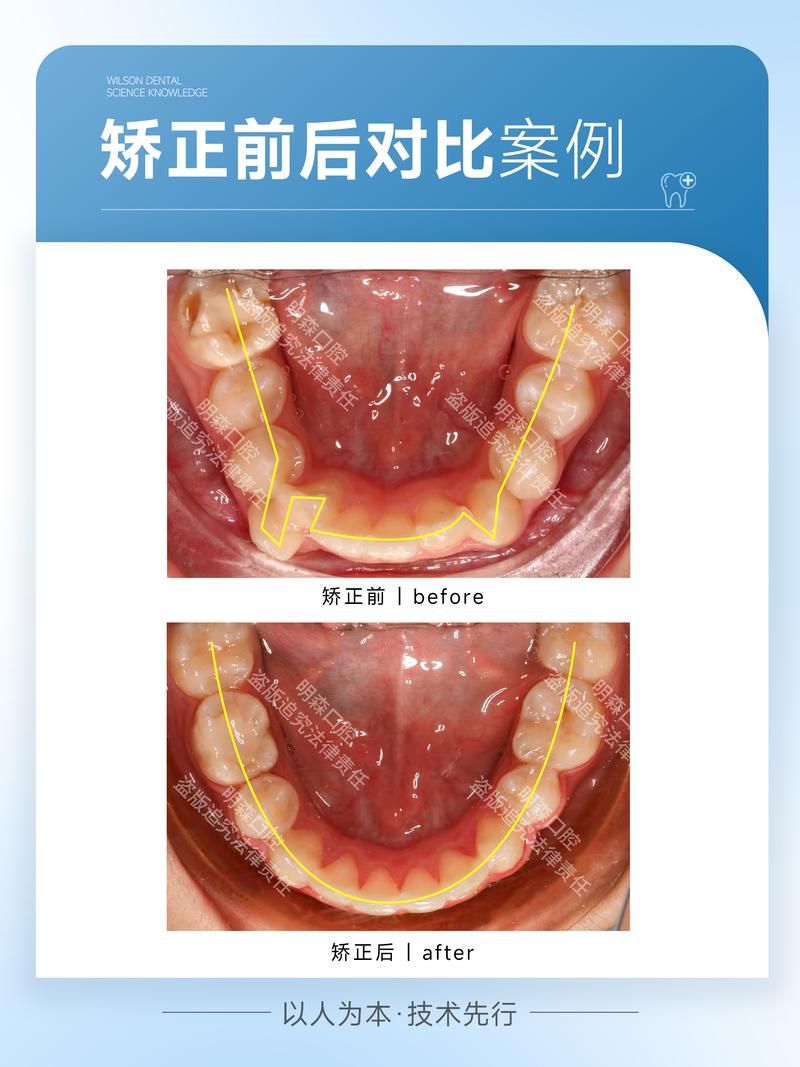 牙齿的‘美容师’：洗牙为何越来越受欢迎
