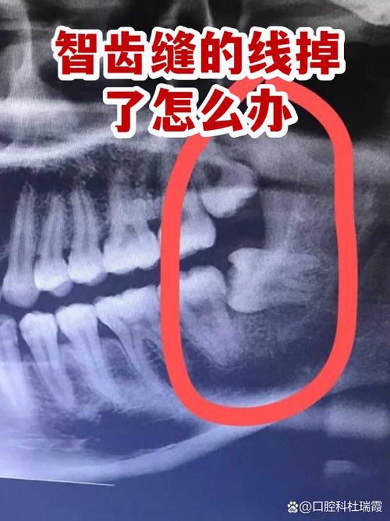 隐形矫正的行业动态：悄然兴起的新风尚