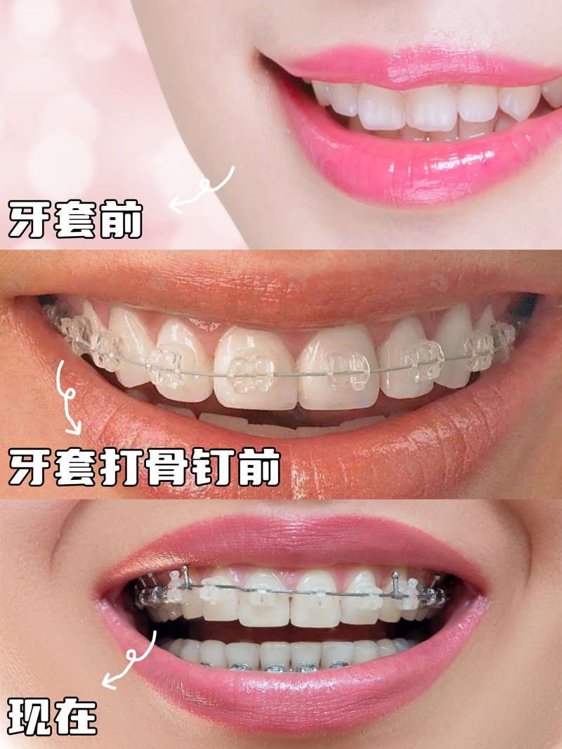 种植牙现状与未来：一场牙齿修复的革命
