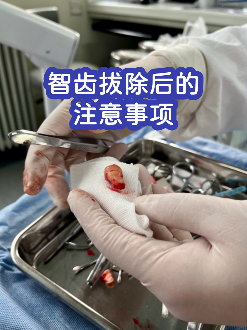 智齿拔除